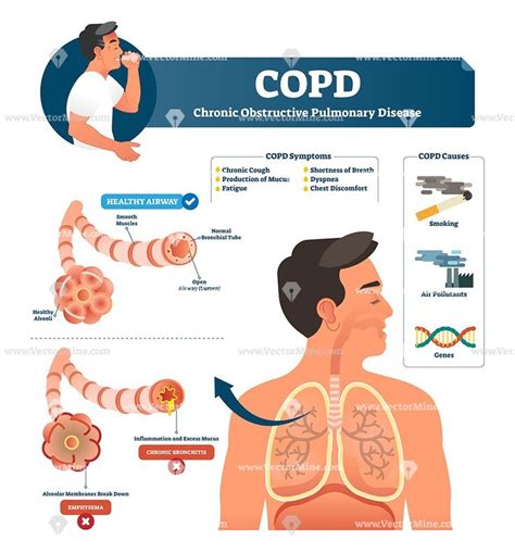 COPD vector illustration – VectorMine | Copd symptoms, Copd, Pulmonary disease