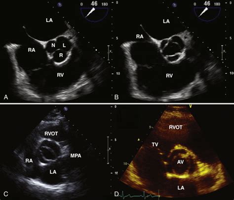 Valves: Echocardiography | Radiology Key