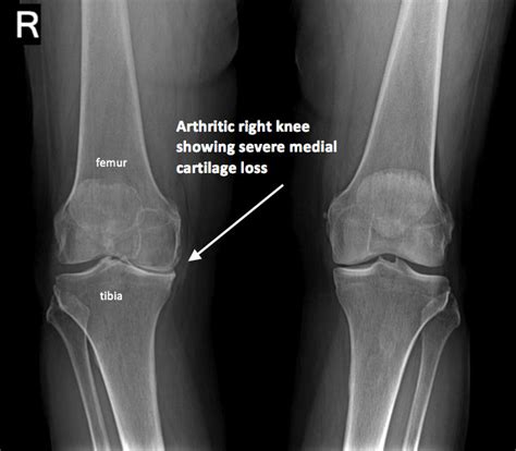 Knee Xray - Santa Monica, CA: Commons Clinic