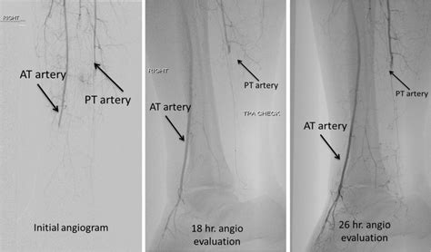 Posteriortibialarteryangiogram