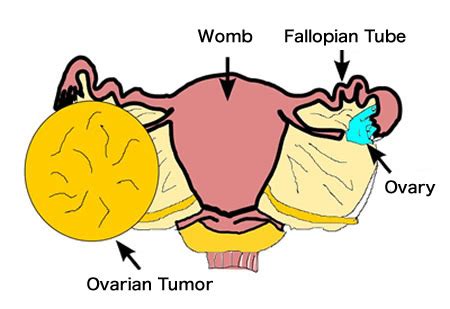 Ovarian Cancer Tumor Types