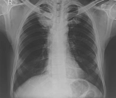 Inferior Vena Cava Syndrome