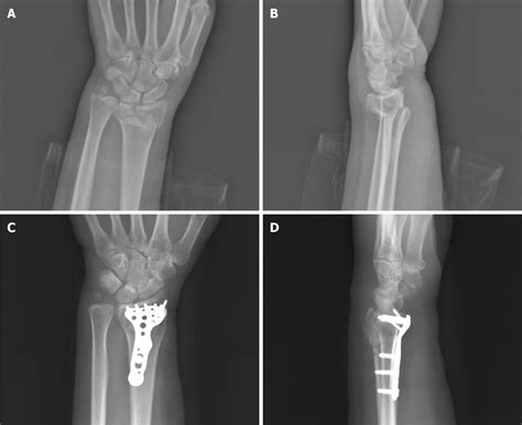 Distal Radial And Ulnar Fracture