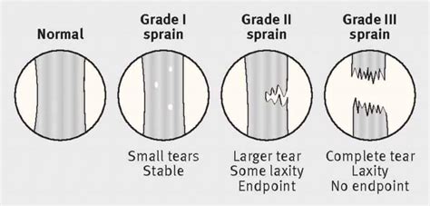 The Complete Guide to an MCL Tear | Kinetic Labs