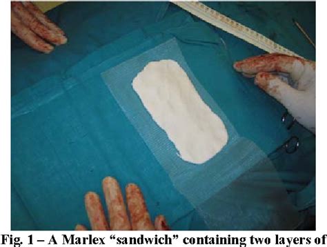 Figure 1 from Use of Marlex mesh with methylmethacrylate to repair ...
