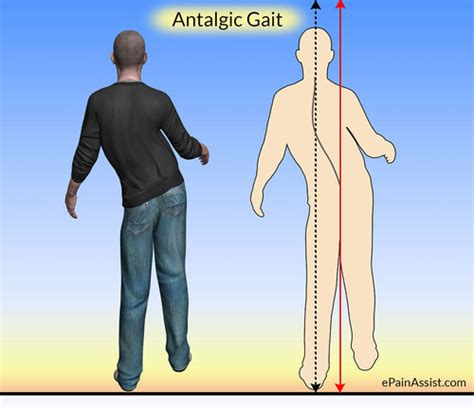 abnormal gait patterns Flashcards | Quizlet