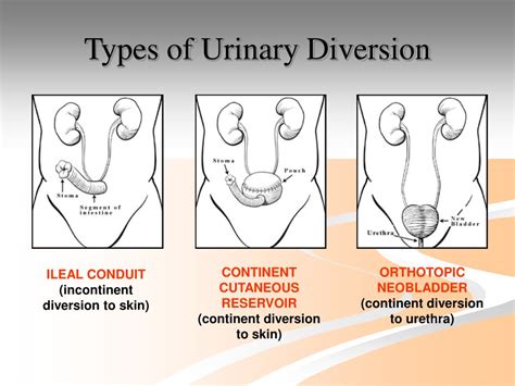 Urinary Diversion Types