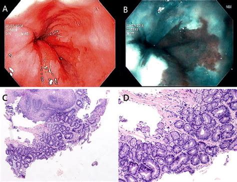 Endoscopic and histological images of a short segment Barrett’s ...