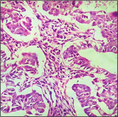 Atypical hyperplasia/endometrioid intraepithelial neoplasia: increased ...