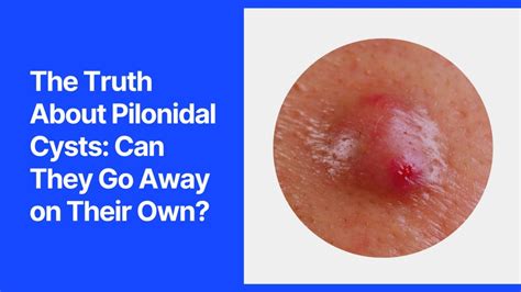 The Truth About Pilonidal Cysts: Can They Go Away on Their Own?