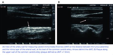 Ultrasound image of carotid arteries | Download Scientific Diagram