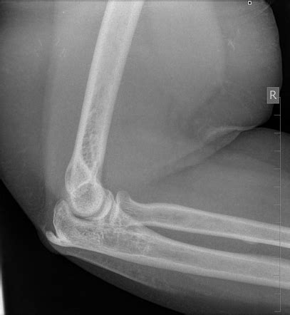 Olecranon spur | Radiology Reference Article | Radiopaedia.org