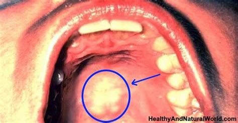 Here's Why You Should NEVER Ignore a Sore on the Roof of Mouth | Roof of mouth sore, Mouth sores ...