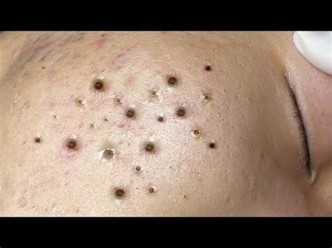 Extreme Blackhead Removal at Nhat Bang Spa #688 - YouTube in 2022 | Blackhead remover ...