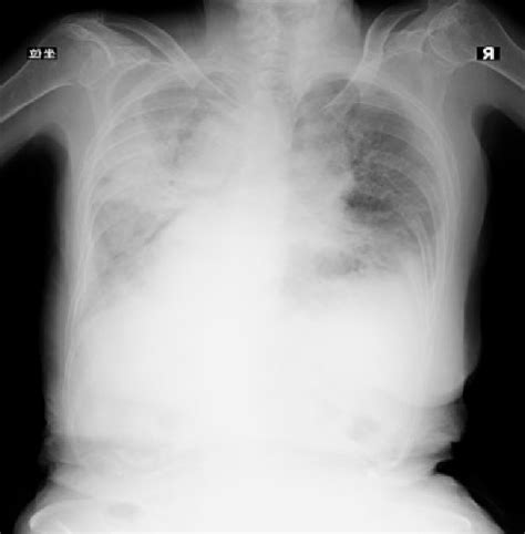 Chest X-ray in admission revealed congestion and cardiac enlargement ...