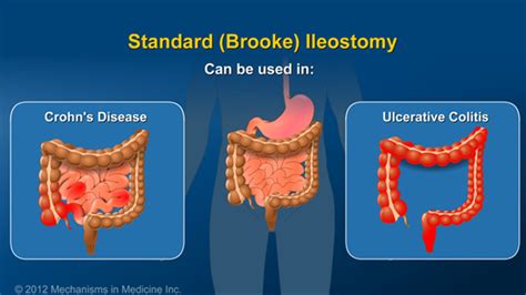 What is an Ileostomy?