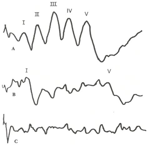 Auditory Brainstem Response | AudGenDB