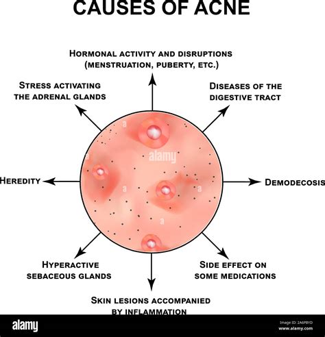 Causes of acne. Pustules, papules, comedones, blackheads, acne on the skin. Infographics. Vector ...