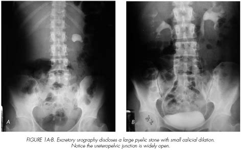 Estenosis ureteral extensa después de nofrolitectomía percutánea