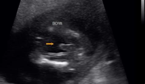 Early Gender Ultrasound