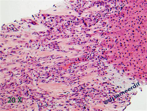 Fibrosarcoma Histology