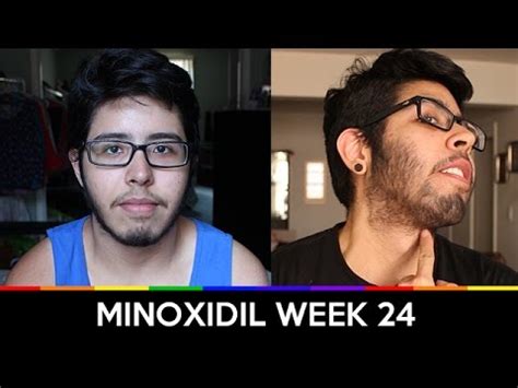 Wow, 6 months on minoxidil. Here’s a timeline of... - Gabriel's Transition