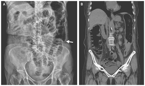 Colon Cutoff Sign | NEJM