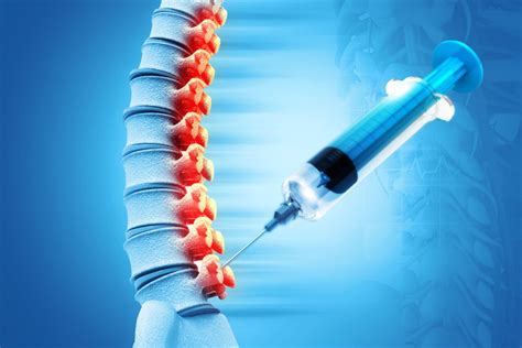 Risks and Benefits of an Epidural Nerve Block | PainScale