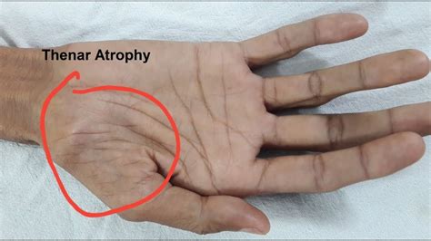 Thenar Atrophy in Motor Neuron Disease - YouTube