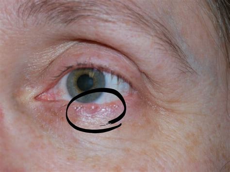 Basal Cell Carcinoma on the Lower Eyelid - Part 1 - Organized 31