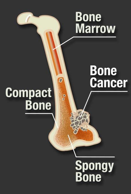 Bone Cancer Pictures