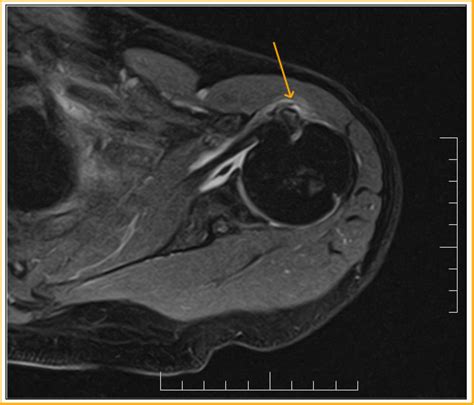 Long Head Biceps Tear-MRI - Sumer's Radiology Blog