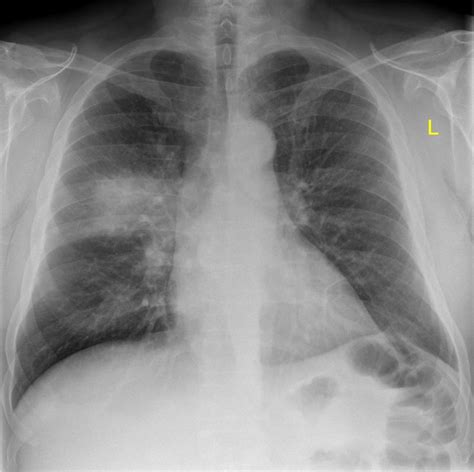 Right upper lobe pneumonia | Radiology Case | Radiopaedia.org ...