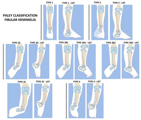 Fibular Hemimelia Limb Lengthening