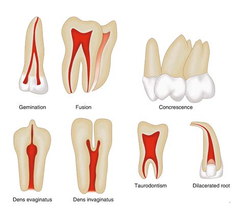 Tooth dilaceration | News | Dentagama