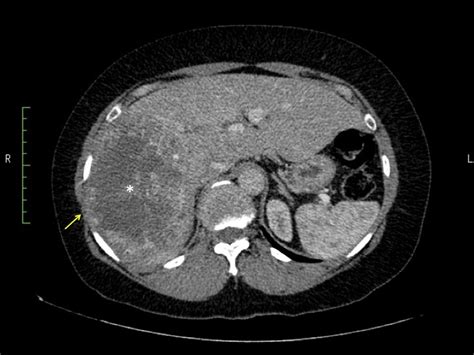 Axial views of a contrast enhanced CT scan of the liver revealing a ...