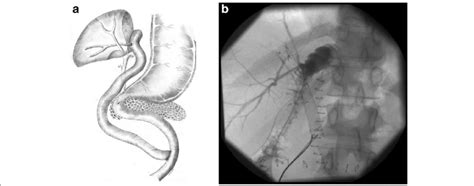 Roux-en-Y hepaticojejunostomy (schematic) with the aberrant right... | Download Scientific Diagram