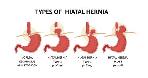 All About Hiatal Hernia After Gastric Bypass - Bari-Life