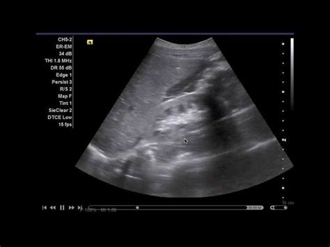 Pin on Abd 200 Mod 3 Ultrasound