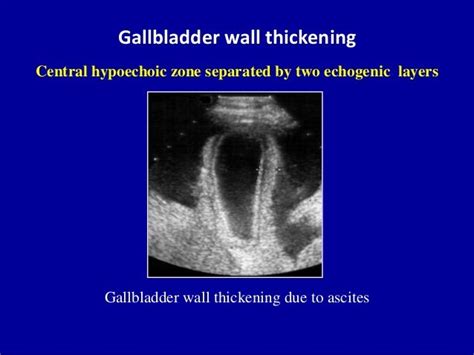 Gallbladder wall thickening Central hypoechoic zone separated by two echogenic layers ...