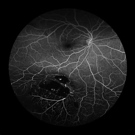 Choroidal Melanoma, 6 Of 8 Photograph by Paul Whitten | Fine Art America