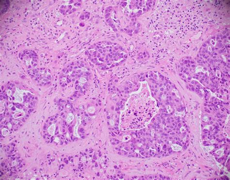 Invasive Ductal Carcinoma Histology