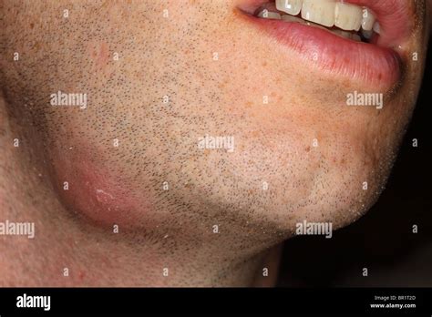 Furunkel oder Abszess im Gesicht Stockfotografie - Alamy