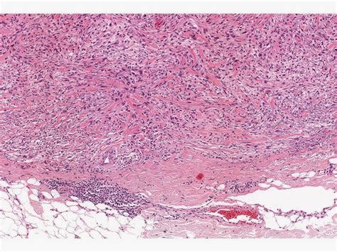 Dermpath Made Simple - Neoplastic: Atypical Fibroxanthoma