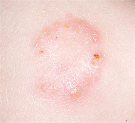 Baby Rashes That Look Like Ringworm | Images and Photos finder