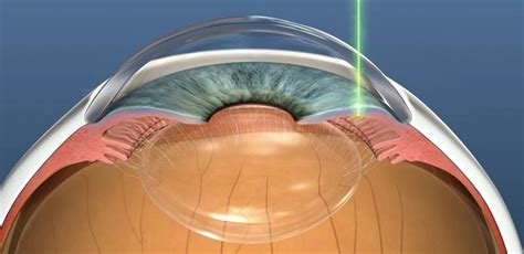 Laser Peripheral Iridotomy - Treat Angle-Closure Glaucoma | Dr Nathan Kerr