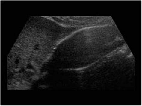 Abdomen and retroperitoneum | 1.2 Gallbladder and bile ducts : Case 1.2.13 Gallbladder ...