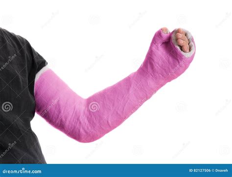 Pink Long Arm Plaster / Fiberglass Cast Stock Photo - Image of fracture ...