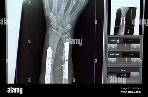 Arm fracture xray Stock Videos & Footage - HD and 4K Video Clips - Alamy