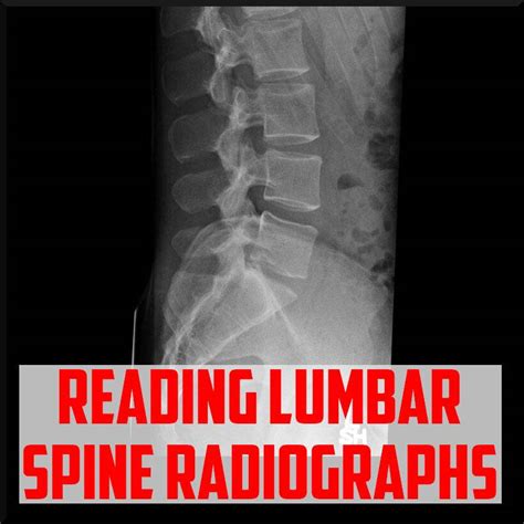 Lumbar Vertebrae Anatomy Xray